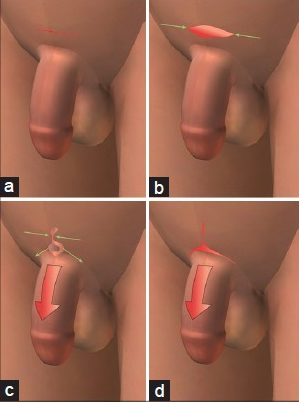 Penoplasty-elongation